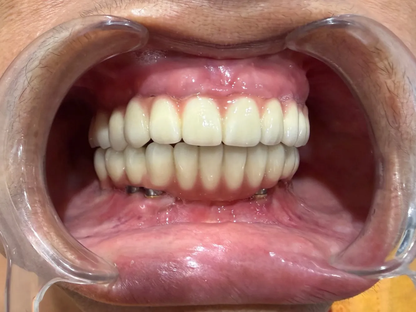 After: Front view, Case 2 · Full-Mouth Rehabilitation