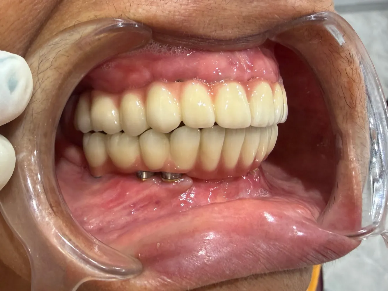After: Left side, Case 2 · Full-Mouth Rehabilitation