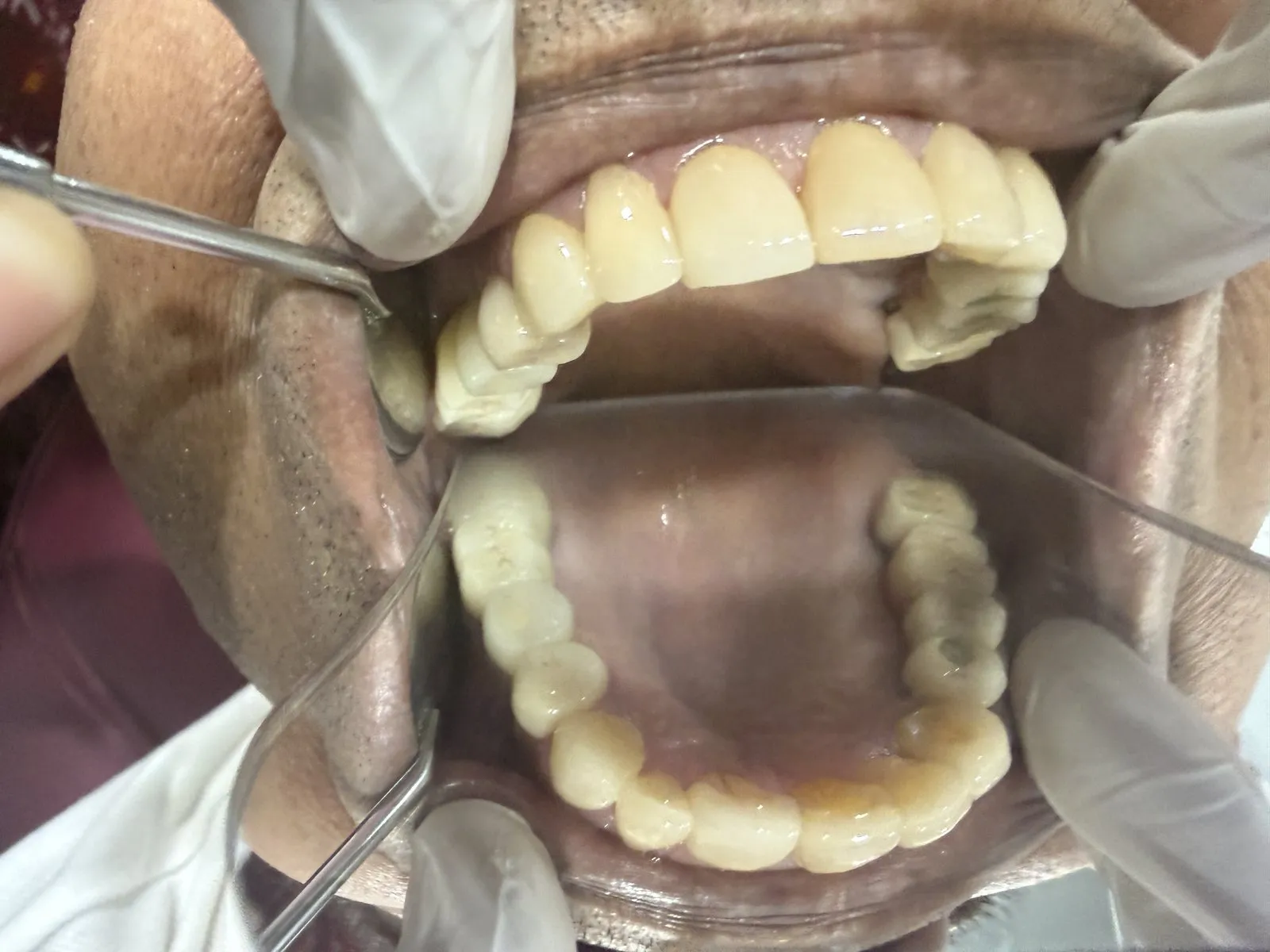 After: Both jaws, Case 1 · Full-Mouth Rehabilitation