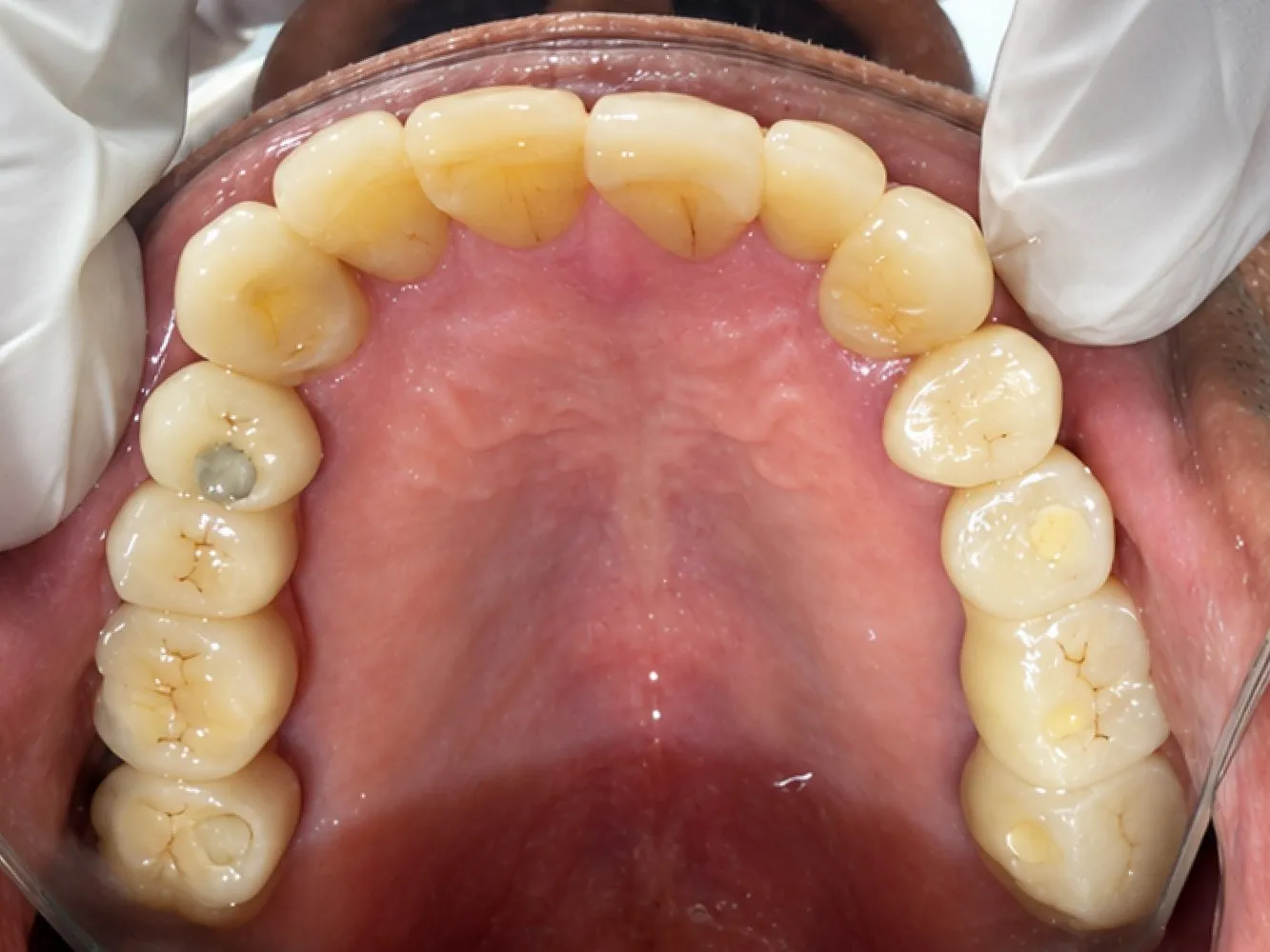 After: Upper jaw, Case 1 · Full-Mouth Rehabilitation