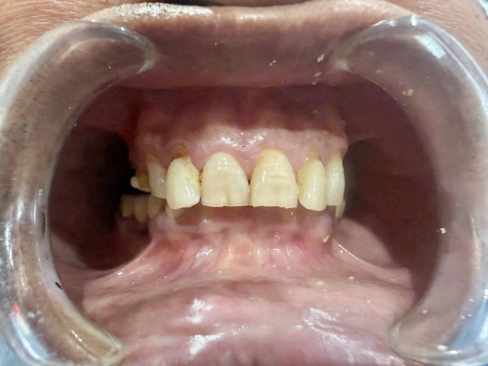 Before: Front view, Case 1 · Full-Mouth Rehabilitation