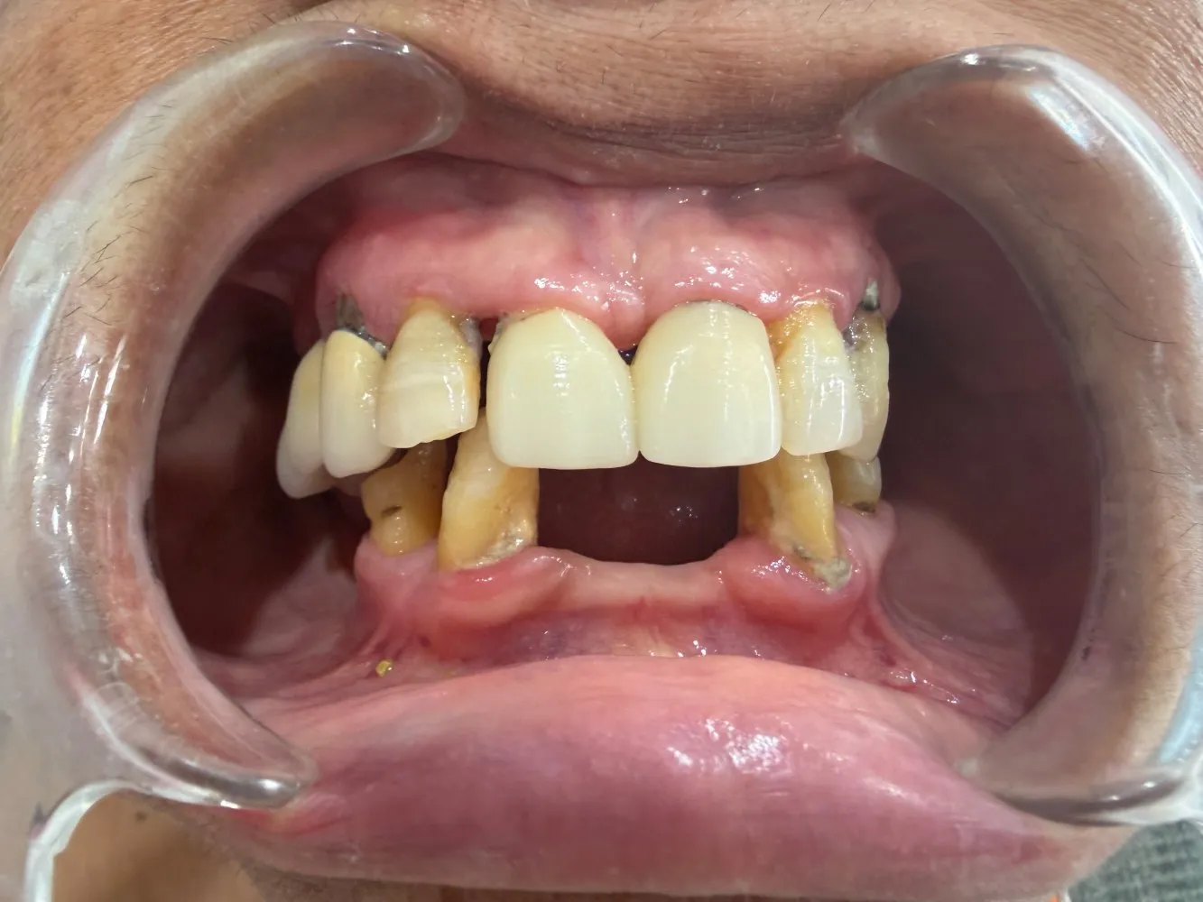 Before: Front view, Case 2 · Full-Mouth Rehabilitation