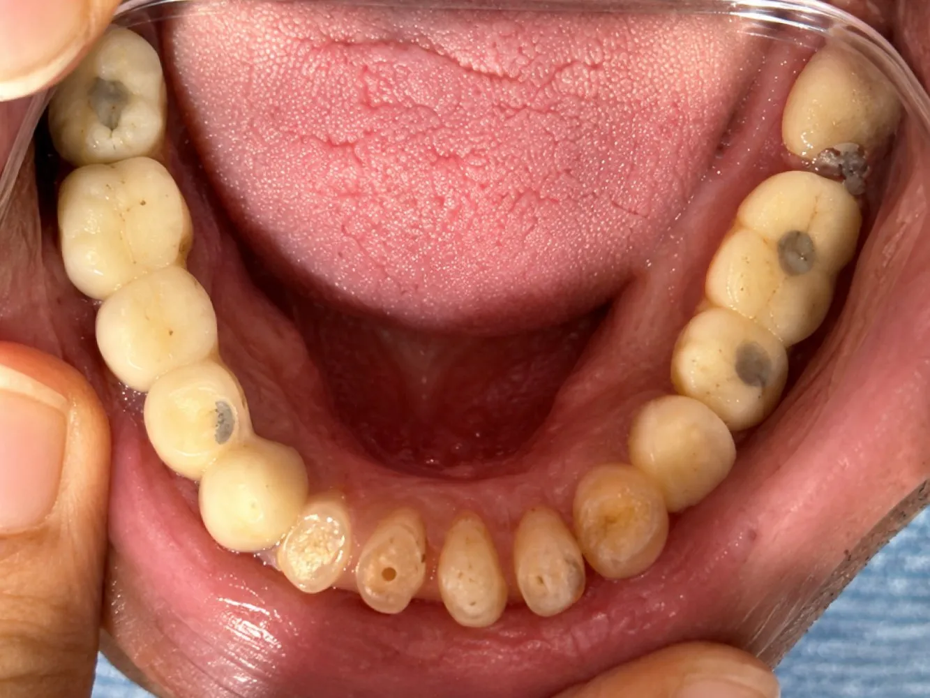 Before: Lower jaw, Case 1 · Full-Mouth Rehabilitation