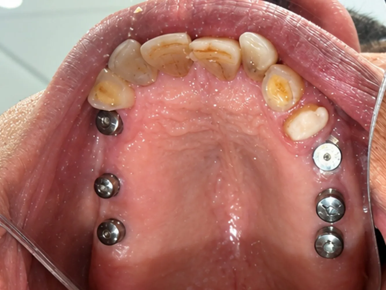Before: Upper jaw, Case 1 · Full-Mouth Rehabilitation