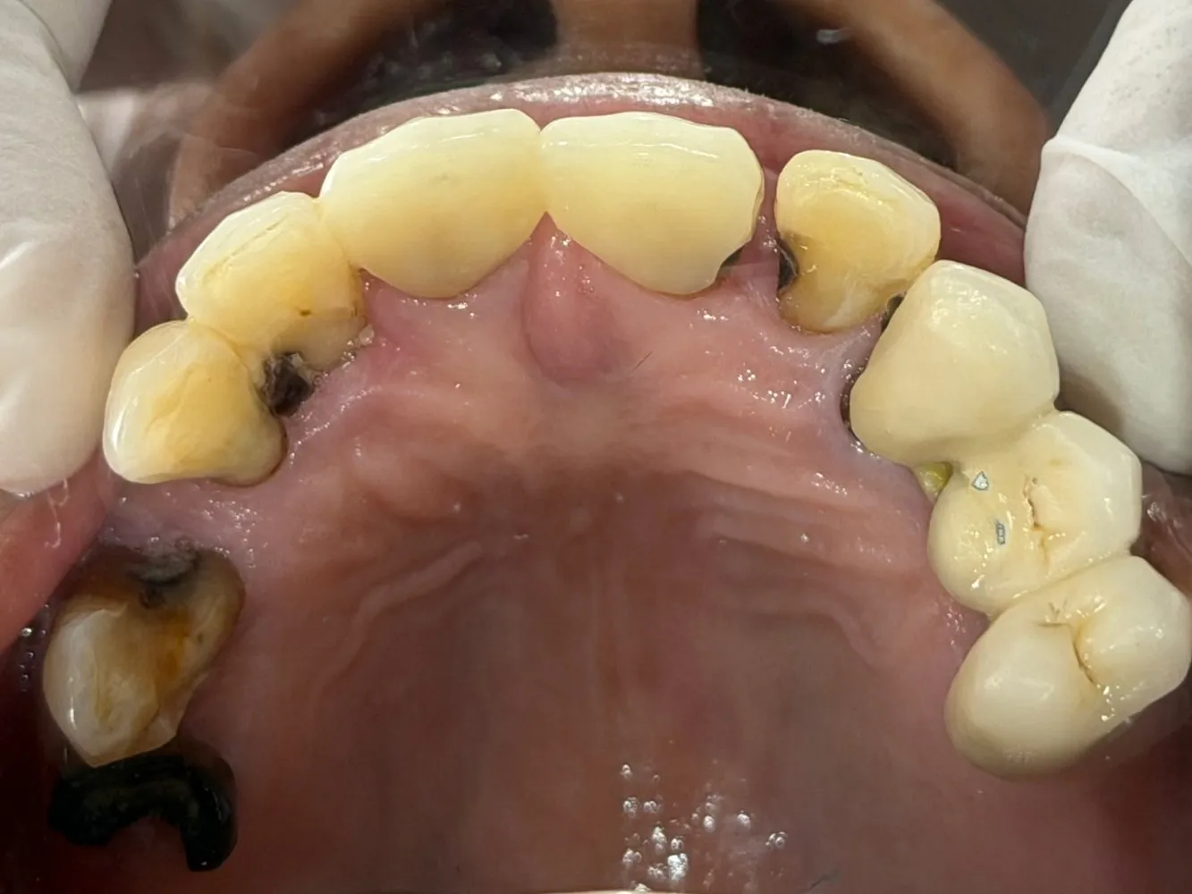Before: Upper jaw, Case 2 · Full-Mouth Rehabilitation